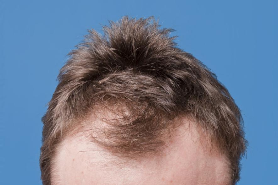 Finasteride for Hair Loss: What You Need to Know