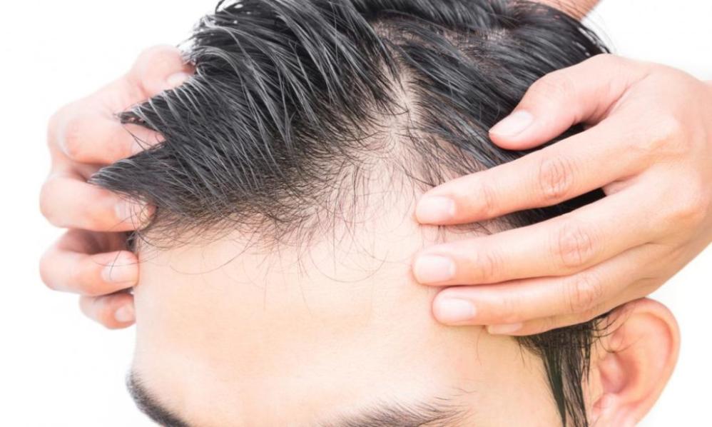 What Are the Different Types of Finasteride?