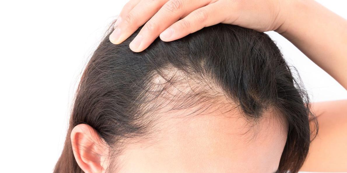 What Are the Best Finasteride Brands?