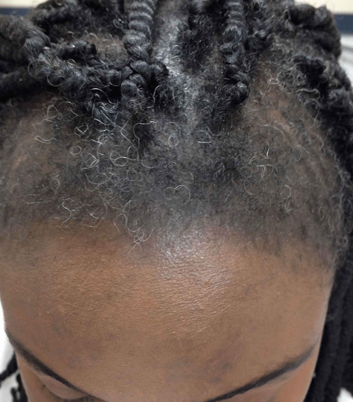 How Does Finasteride Work to Treat Alopecia in Young Men?