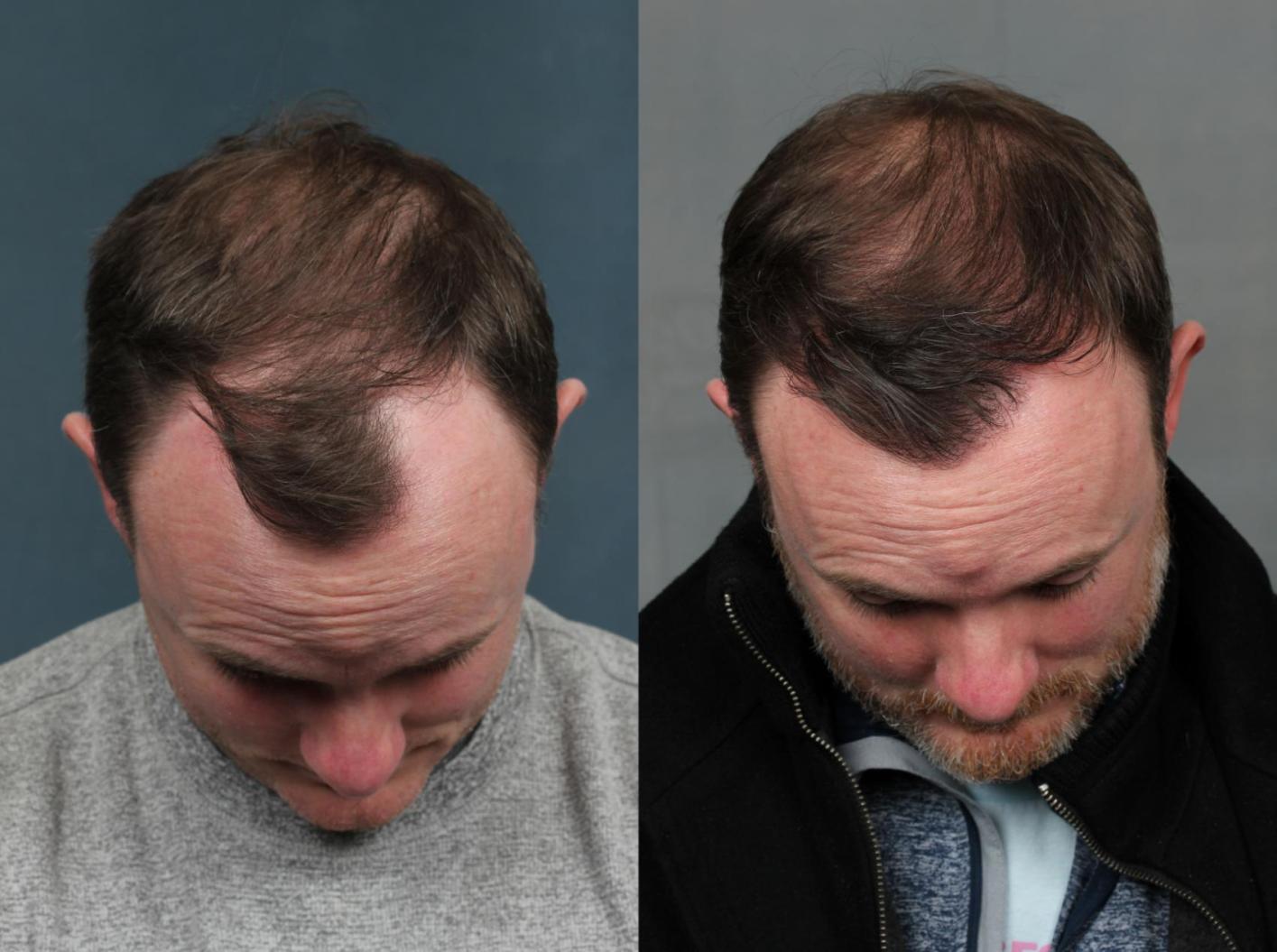 What Are the Alternatives to Finasteride for Hair Transplants?