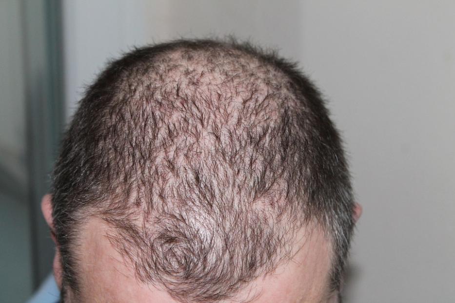 How Long Does It Take for Finasteride to Work for Hair Transplants?