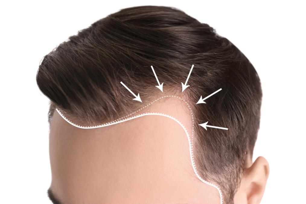 What Are the Clinical Trials of Finasteride for Male Pattern Baldness?