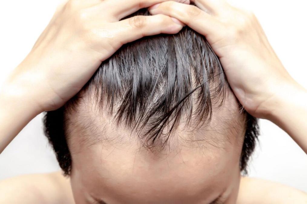 What Are the Patient Reviews of Finasteride for Male Pattern Baldness?